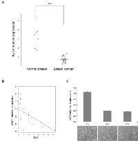 Figure  5:  KLF9   is  downregulated  in  human  breast  cancer.