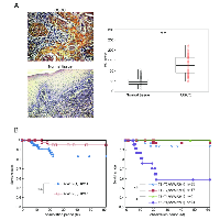 Figure 6:  Evaluation of WWP2 protein expression in primary OSCCs and correlation with poor prognosis. 