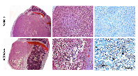 Figure 4:  AZD6244 treatment triggered central apoptosis in late stage knee metastases. 