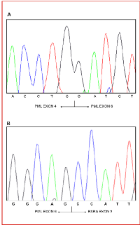 Figure  5: PML-RARA  variant  with  exon  5  deletion. 