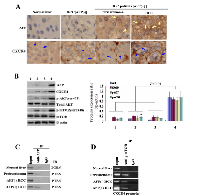 Figure 1: Effects of alpha-fetoprotein(AFP) on expression of CXCR4 in hepatocellular carcinoma(HCC) clinical  patients’ sample tissues. 