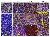 Figure 6:  Immunohistochemical analysis of NRP1 expression in medulloblastoma tumor tissues. 