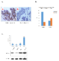Figure 1: STMN1 expression increased with chemoresistance to TX in human ovarian cancers. 