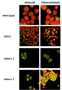 Figure  3:  Immunofluorescent  images  of  mTOR  protein  localization  in  RPMI8226  and  OPM2  cells  and  primary  myeloma cells. 