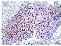 Figure 5:  Representative immunohistochemical staining of the mTOR protein nuclear localization in MM bone  marrow sample. 