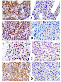 Figure 6:  Representative immunohistochemical staining of MM bone marrow samples for p-AKT (A), p-mTOR (B),  p-P706SK (C) and p-4E-BP1 (D).The right panel shows negative immunoreactivity, while the left panel shows strong  positive immunoreactivity for the specific antibodies. 