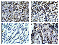 Figure  1: Expression  of  Brm  in  Brg1/Brm  double  knockout  mouse  lung  tumors. 
