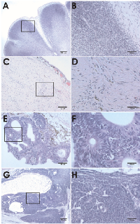 Figure 4:  Histological analysis of hind limb, desmoid,  epidermal and brain neoplasias of apc  TALEN mRNA  (40 pg) injected tadpoles and froglets. 