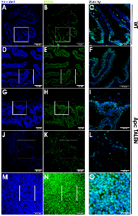 Figure 6:  Increased and mislocalized proliferation in apc  TALEN induced tumors. 