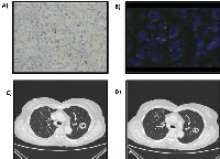 Figure 1:  A) Estrogen Receptor, B) FGFR2 Amplification; C) Target lesion at  basal CT scan , D) Target lesion after 12 months of treatment.