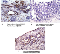 Figure 4:  A Immunohistochemistry (IHC) staining  of Pancreatic carcinoma (positive control), 4B:  Normal colonic mucosa (negative control); 4C: colonic  adenocarcinoma.
