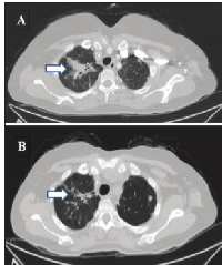 Figure 1: Representative CT scan images of upper  lung metastasis at baseline (A) and after 3 months of  trastuzumab and chemotherapy (B).