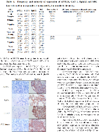 Figure 4:  Representative immunohistochemical  staining of melanoma samples showing ANXA1, CAV- 1, EphA2 and SRC kinase positive staining. 