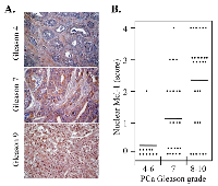 Figure 6:  Nuclear localization of Mcl-1 is more frequent in high Gleason grade PCa.  (A) 