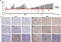 Figure 5:  Astrocytic glioma tissue arrays for EGFR and EFEMP1. 