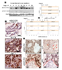 Figure 2:  pSTAT3 Tyr705 and Ser727 expression in advanced human ovarian tumors. 