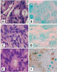 Figure 9:  The effect of hrRNASET2 on tumor cell apoptosis. 