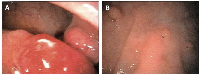 Figure 1: Clinical aspects of intestinal polyps in a patient suffering from Cowden syndrome.