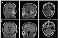 Figure 2:  Meningioma in a patient with Cowden syndrome.