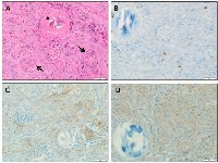 Figure 3:  Histological features of meningioma in Cowden syndrome.