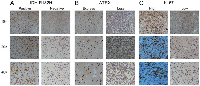 Figure 1:  Detection of ATRX, IDH1-R132H and Ki-67 in astrocytic tumors by immunohistochemistry.