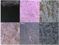 Figure 2:  Tissue pathological confirmation of the primary mass.