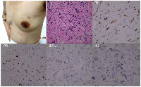 Figure 3:  Reassessment of the primary tumor after neoadjuvant chemotherapy.