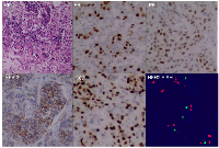 Figure 5:  Surgical pathology of the brain metastatic lesion.