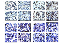 Figure 2: A. illustrates Pcna expression by IHC in adenomas from WT (Brg1+/+Brm+/+) (a), Brg1 knockout (Brg1-/-Brm+/+) (b), Brm-null (Brg1+/+Brm-/-) (c) and double KO (Brg1-/-Brm-/-) (d) mice. B. shows the relative Pcna expression in lung adenocarcinomas from DKO (d) >Brg1-KO (b), Brm-null (c) and > WT (a) mice. Magni cation bar (right lower corner) = 40 Î¼m. According to C. very few cells express Ki-67 in the nucleus (arrows) in adenomas from a WT mouse (a), Brg1 KO mouse (b), Brm-null mouse (c), and a DKO mouse (d). D. shows that, compared with adenomas, a higher percentage of cells express Ki-67 protein (arrows) in adenocarcinomas from a WT mouse (a), a Brg1 KO mouse (b), a Brm-null mouse (c) and a DKO mouse (d). Microscope bar = 20 Î¼M.