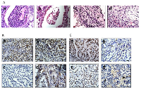 Figure 3: A. shows local progression of a malignant adenocarcinoma into a blood vessel (a), a cluster of tumor cells invading a bronchiolar airway (b), the presence of tumor cells in the stroma (large tumor cells, arrow) alongside spindle-shaped  broblasts (arrowheads) (c) and tumor cells surrounding and invading a nerve (d). B and C. contain representative images of Brm and Brg1 expression in tumors, respectively, as detected by IHC in tumors from the four genotypes: WT (a), Brg1-KO (b), Brm-null (c) and DKO (d); arrows indicate Brg1- positive cells within the Brg1-KO and DKO tumors.