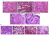 Figure 4: A. shows the various differentiation states (well, moderate and poor) as illustrated by H&E staining. The well-differentiated tumor shows well-formed papillary and glandular structures and mild cytological atypia (a). The moderately-differentiated tumor is composed of irregular glandular structures, moderate cytological atypia and occasional mitotic  gures (b). The poorly-differentiated tumor shows a predominantly solid growth pattern, marked cytological atypia and increased mitotic  gures (c). Low (d) and high (e) magni cation of a high-grade tumor with prominent nucleoli and mitotic  gures. Magni cation bar = 20 Î¼M in a-c; 10 Î¼M in e. B. illustrates a tumor with sarcomatoid morphology, the most poorly differentiated variant (a), a cluster of signet ring cells (arrows) (b), mucinous tumor cells with cytoplasmic vacuoles (black arrows) (c), and a pale staining area of  brosis with tumor cells (black arrows) (d).