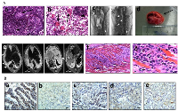 Figure 5: A. shows a sheet of lymphocytes (arrowhead) and a cluster of macrophages (arrow) (a), as well as several multinucleated giant cells (arrows) have in ltrated these tumors; arrowhead, lymphocytes (b). Also illustrated is the studding (tip of white triangles) of the ribcage after gross dissection of a DKO mouse with the lungs in place and after the lungs were removed (c). One of the tumors noted in the MRI was removed and examined and was revealed to be ~2 cm in length and contain a clear  uid indicative of a pleural effusion (black arrow) (d). MRI images of the larger adenocarcinomas of the lungs, the ribcage mets (denoted by white triangle tips), as well as and pleural effusions (white lines) are shown in (e). H&E stain of malignant lung adenocarcinoma cells that have penetrated through the chest cavity into the intercostal muscles of the ribcage in a BRG-/- mouse at low mag 10x (f) and high mag 40x (g). B. shows strong E-cadherin expression in a lung adenocarcinoma derived from a WT mouse (a), but much weaker staining in tumors from a Brg1-KO mouse (b), a Brm-null mouse (c), and a DKO mouse, where E-cadherin expression is almost completely absent (d). There is minimal to no expression of E-Cadherin in a metastatic rib met (e), which was derived from the mouse in (b).