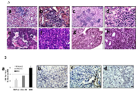 Figure 6: A. shows a low (a) and high (b) magni ed image of a kidney met from a Brg1-KO mouse; (c) and (d) show a liver met from the same mouse; a low (e) and high (f) mag image of a kidney met from a DKO mouse that features a dense sheet of tumor cells; a colon met from a Brg1-KO mouse displays spindle-shaped sarcomatoid tumor cells surrounding the normal glandular structures (g-h). B. shows the results of qPCR of multiple tumors for E-cadherin and the fold-change of E-cadherin expression in several Brm-null, Brg1-KO and DKO tumors relative to WT tumors (a). A colon met (b), a kidney met (c) and a liver met (d) from several BRG-de cient mice; the arrow in (c) denotes normal kidney. Magni cation bar = 20 Î¼m.