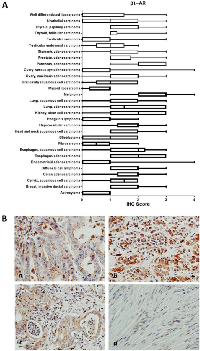 Figure 2:  β1-AR receptor protein expression in cancer tissues. 