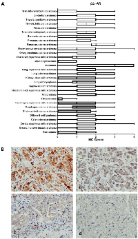 Figure 3:  β2-AR receptor protein expression in cancer tissues. 