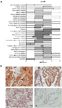 Figure 4:  β3-AR receptor protein expression in cancer tissues. 