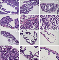 Figure 2:  Expression of KrasG12D in the gallbladder epithelium using Pdx1-Cre induces adenoma and low-grade  adenocarcinoma. (A-D) 