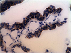 Figure 3C:  IHC staining of colonic adenocarcinoma.