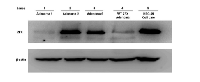 Figure 3:  Western blot analysis of ZFX  expression in  parathyroid adenomas. 