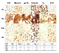 Figure 2:  Detection of melanoma specific antigenic markers by immunocitochemistry. 