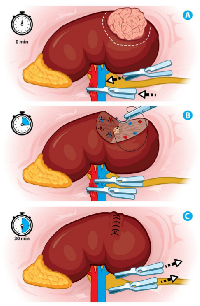 Figure 2:  Ischemia techniques. 