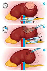 Figure 3:  Ischemia techniques. 