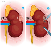 Figure 4:  (A) Tumor lesion in the middle renal segment with controlled hypotension MAP of 60-70 mmHg, (B) complete  resection of tumor lesion with minimal renal parenchymal bleeding. 