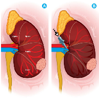 Figure 5:  Zero ischemia technique. 