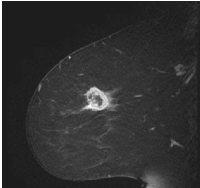 Figure 1: Sagittal T1 post-contrast MRI of a 48-year- old  female  patient  diagnosed  with  infiltrating  ductal  carcinoma (ER-, PR-, HER2-) shows an oval rim  enhancing mass. 