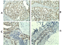 Figure 1: Immunohistochemistry staining of DCIS  samples  using  monoclonal  antibody  specific  to  NY- ESO-1 (clone E978) (shown in brown). 