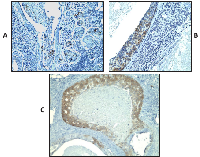 Figure 2:  Immunohistochemistry staining of DCIS  samples using monoclonal antibody specific to MAGEA  (clone 6C1) (shown in brown). 