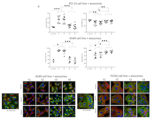 Figure 4:  Alterations in expression levels of EpCAM or Vimentin in PCI-13 and A549 cells co-incubated with plasma  exosomes from HNSCC patients undergoing PDT. 