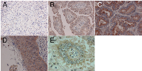 Figure 1: Nucleolar and cytoplasmic PICT1 expression in non-small cell lung cancer. 
