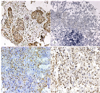 Figure 1: (A) Cytoplasm staining of BRCA1 in  neoplastic cells from an oral squamous cell carcinoma  (OSCC). 